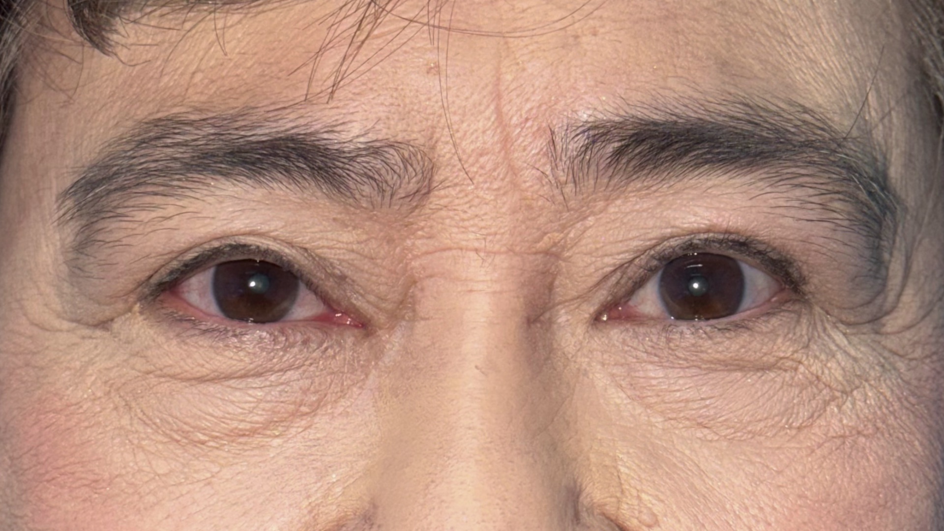 Eight months after levator advancement for ptosis