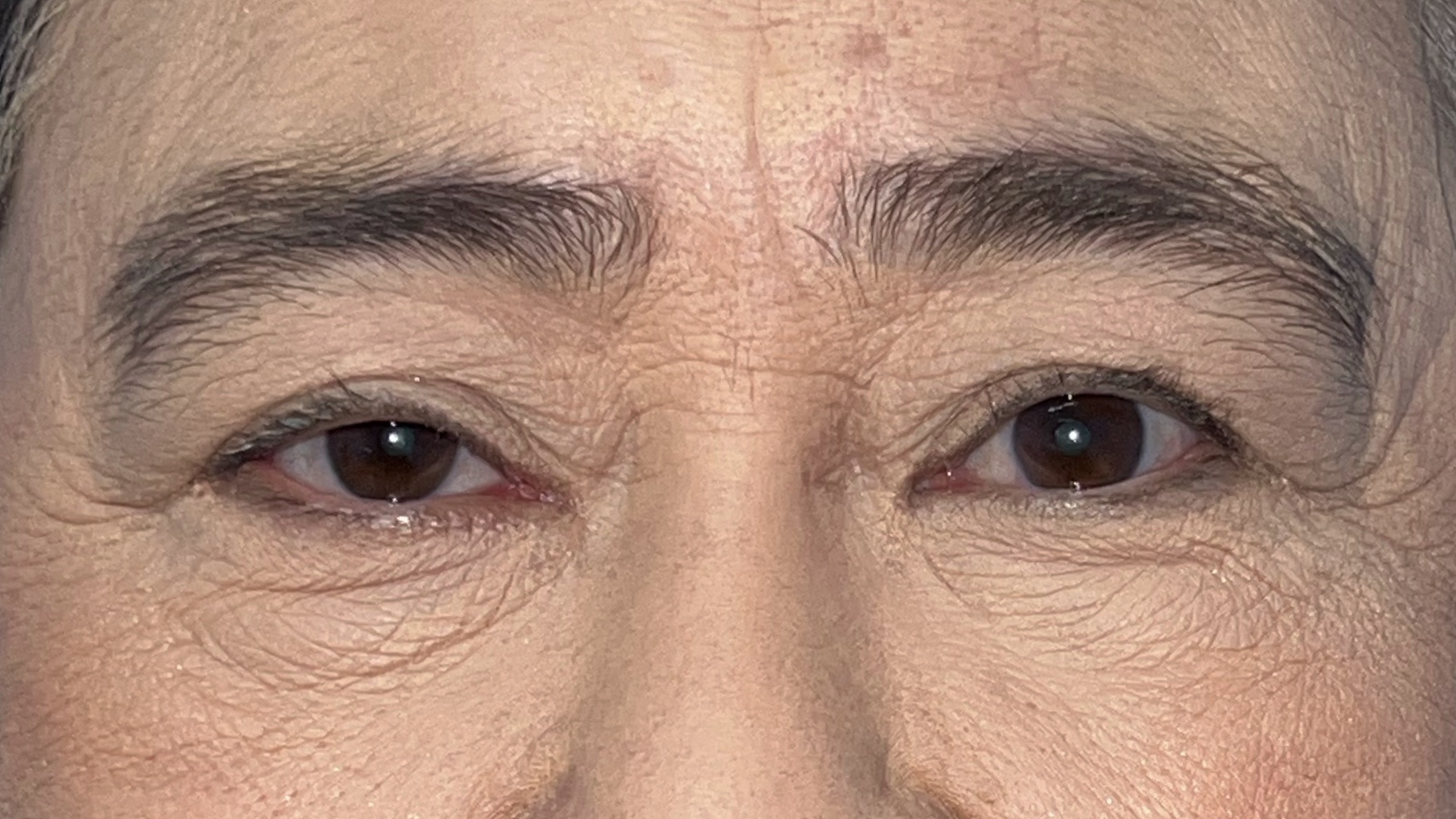 Before levator advancement for ptosis