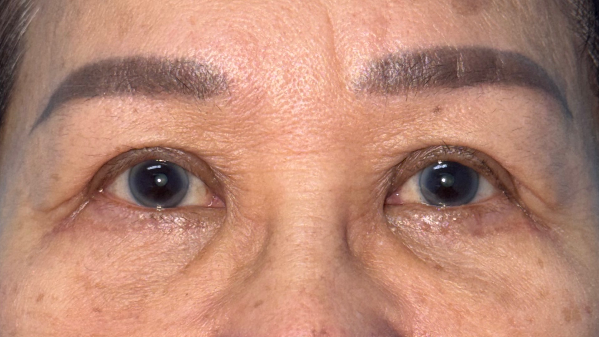 Four and a half months after levator advancement for ptosis