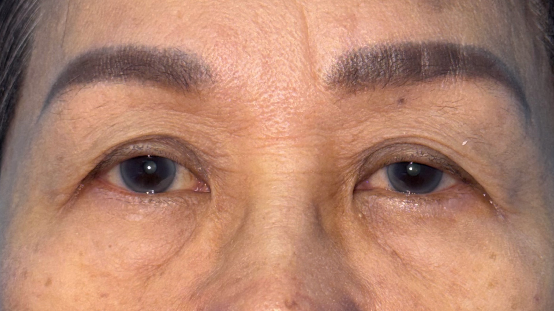 Before levator advancement for ptosis