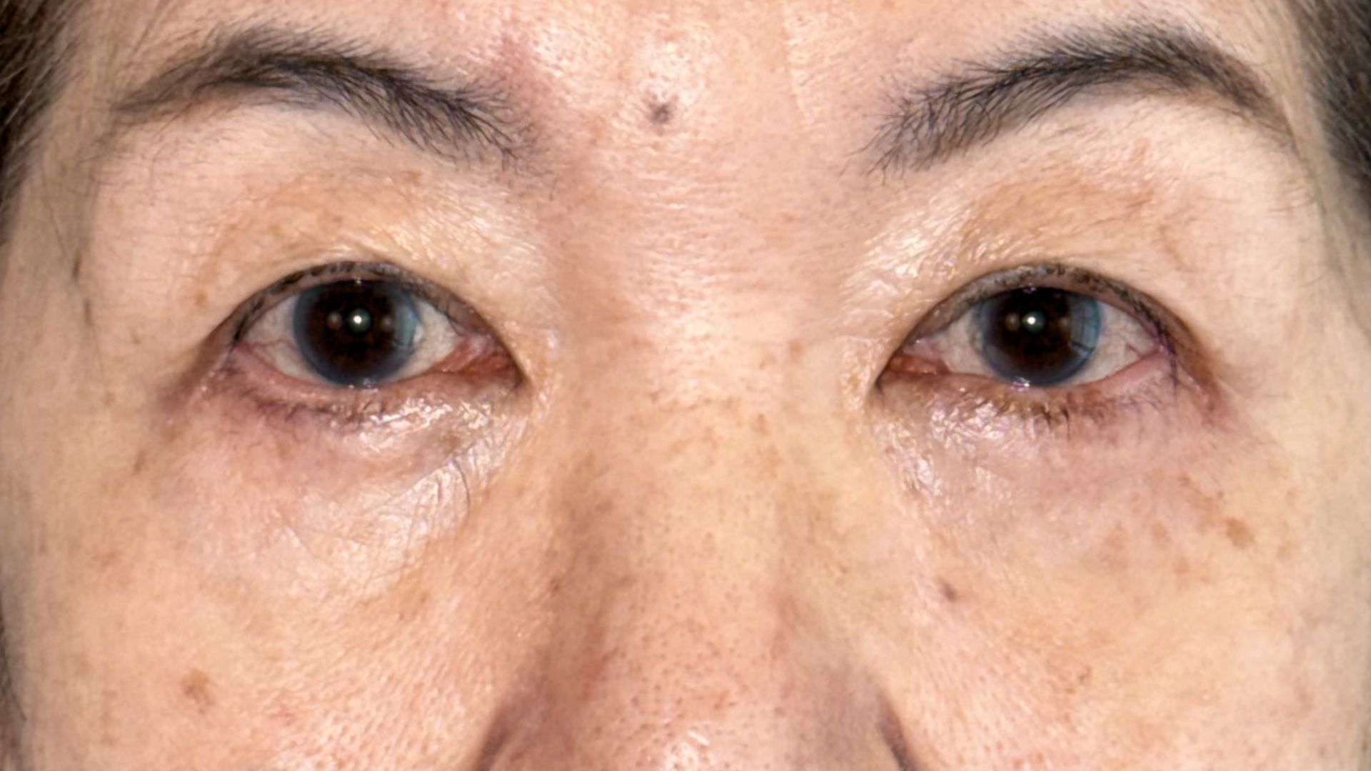 One year after Lower Blepharoplasty, Case 010