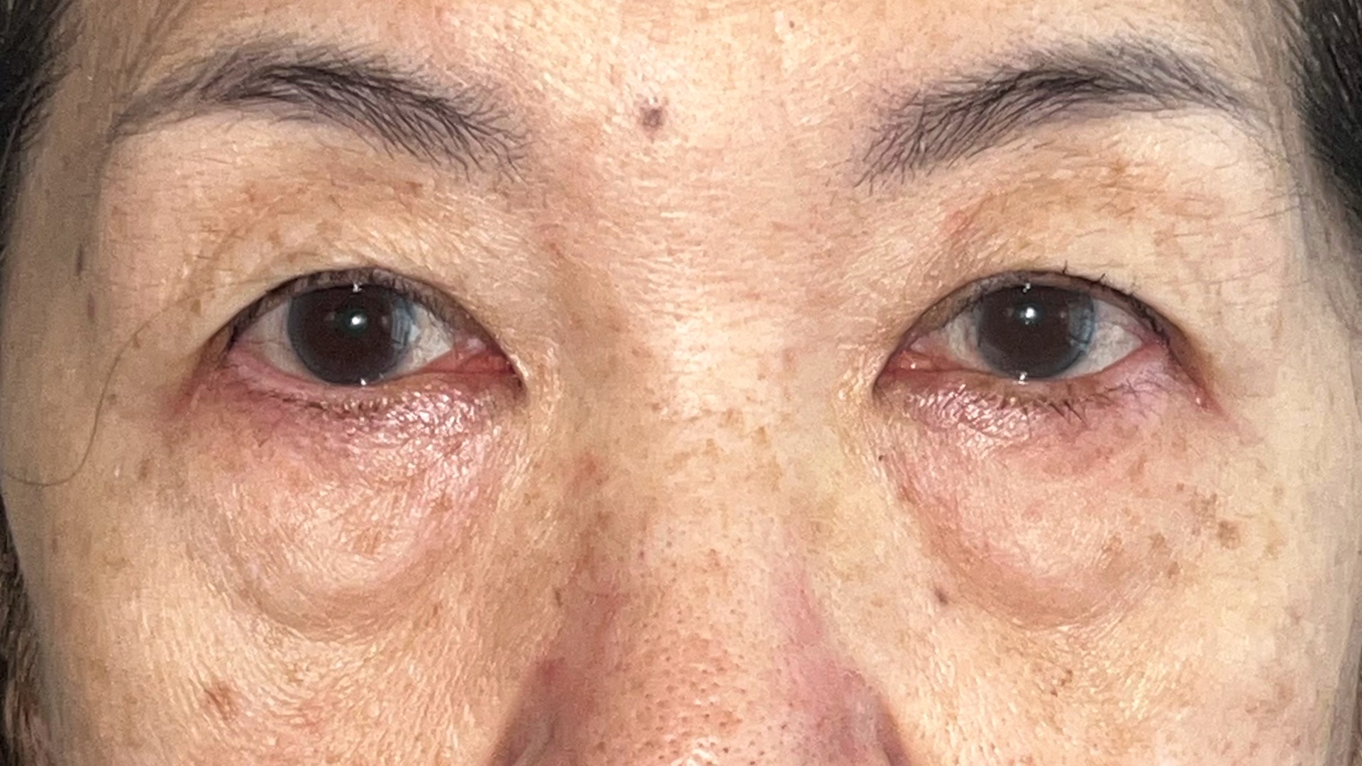 Before Lower Blepharoplasty, Case 010