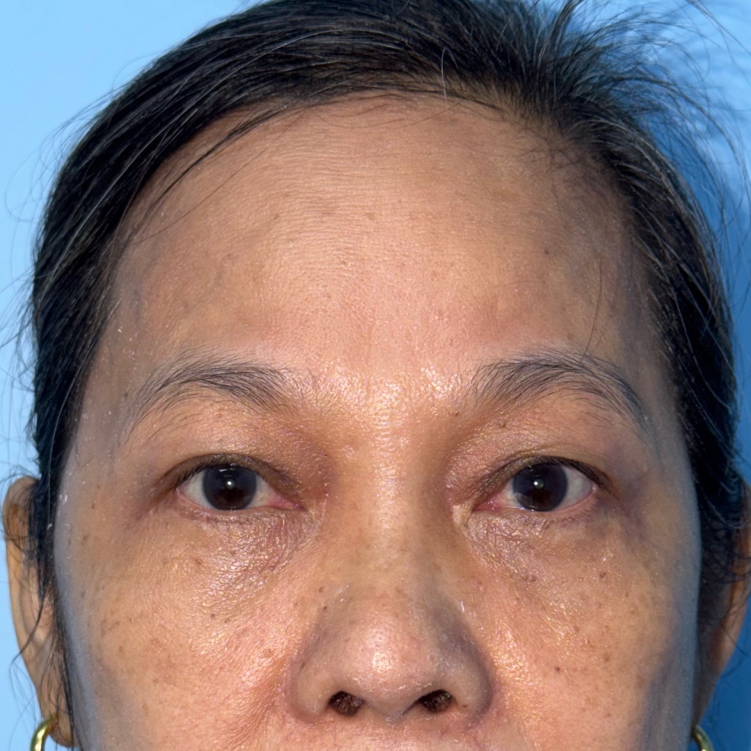 Five months after Endoscopic Brow Lift and Lower Blepharoplasty