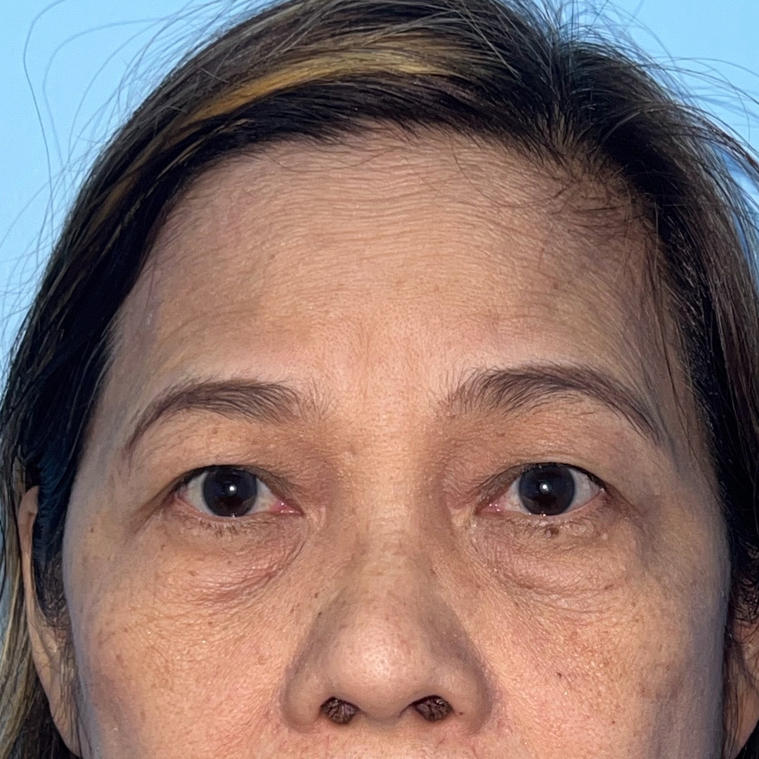 Before Endoscopic Brow Lift and Lower Blepharoplasty