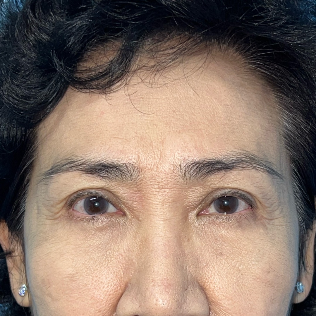 Ten months after Endoscopic Brow Lift and Lower Blepharoplasty
