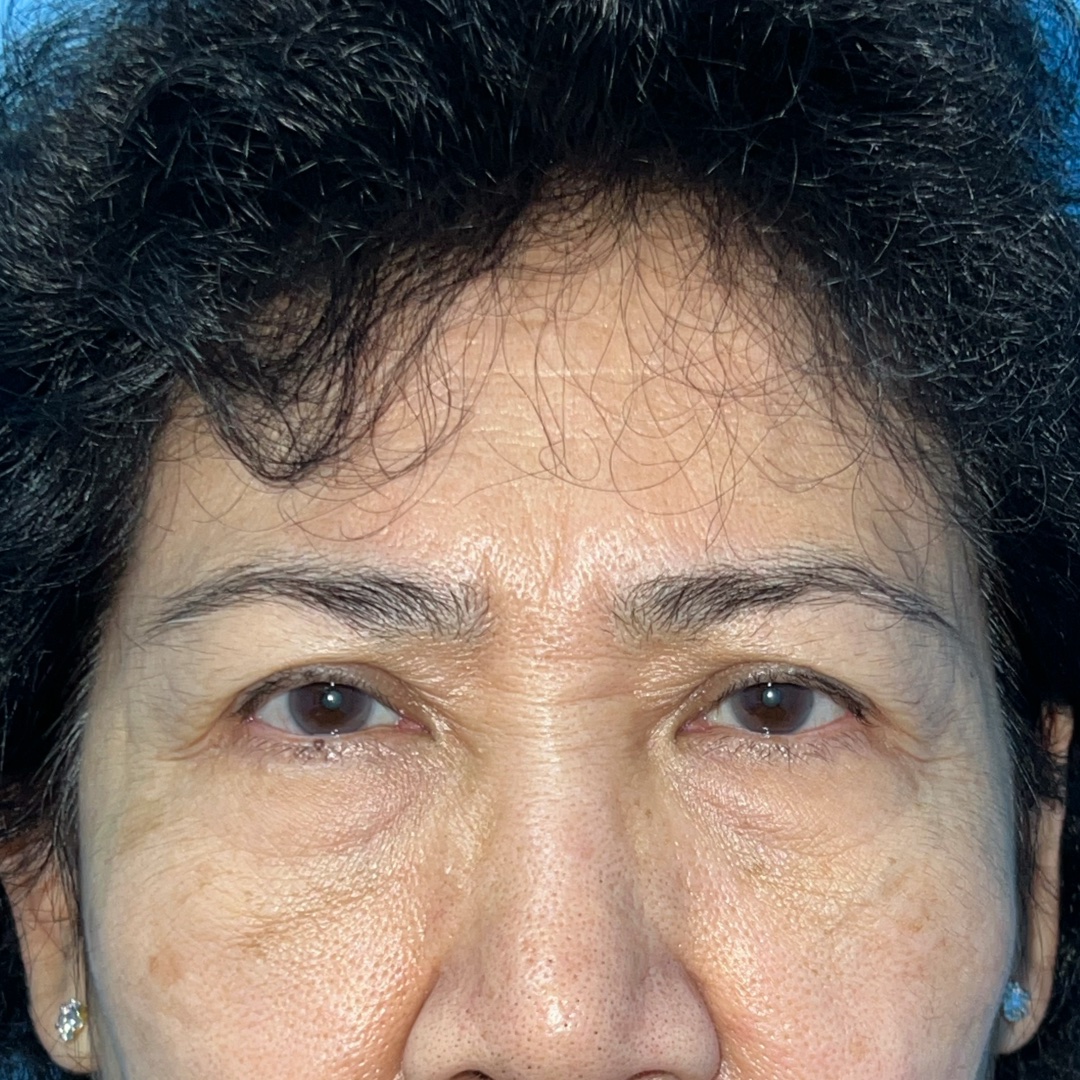 Before Endoscopic Brow Lift and Lower Blepharoplasty