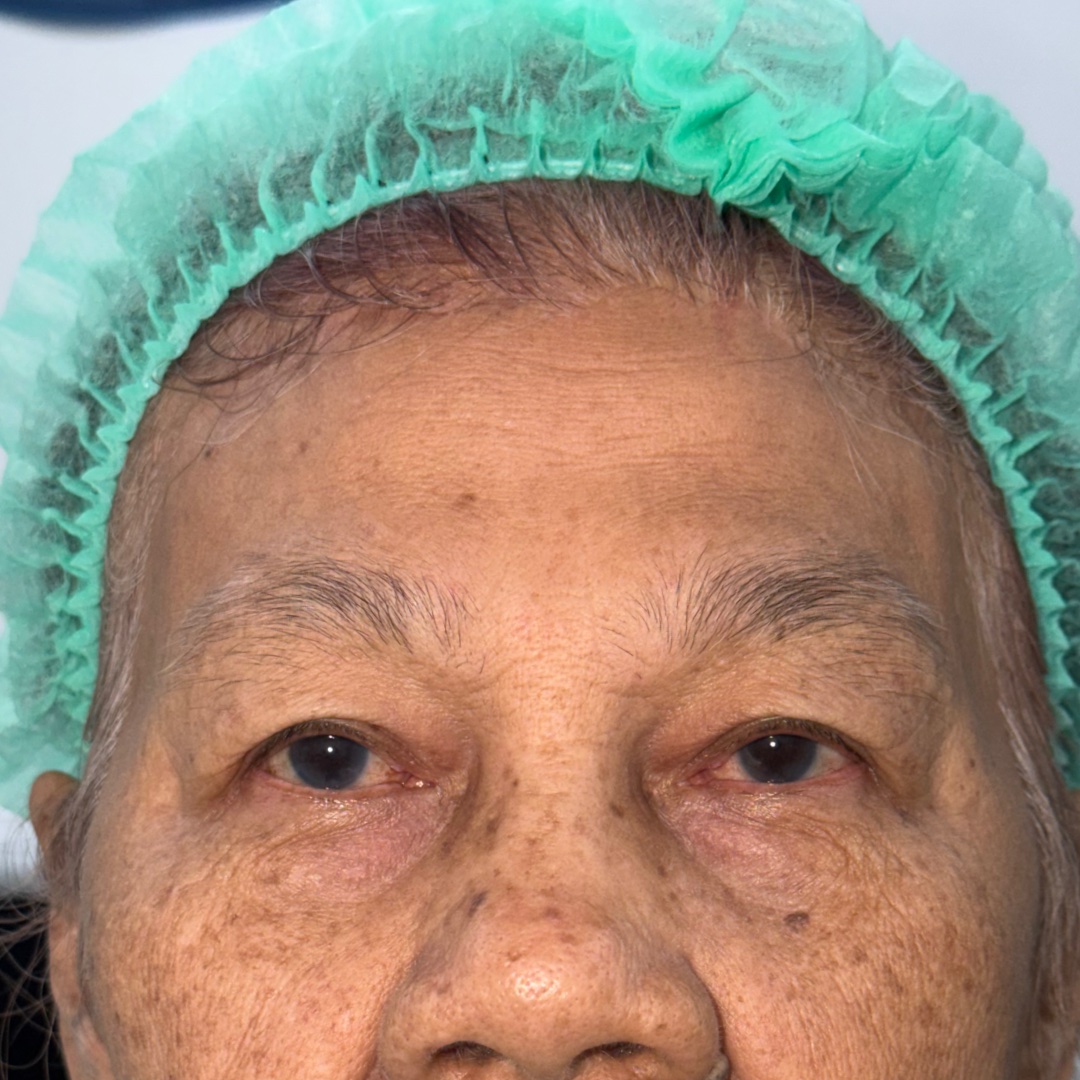 Five months after Hairline Forehead Lift