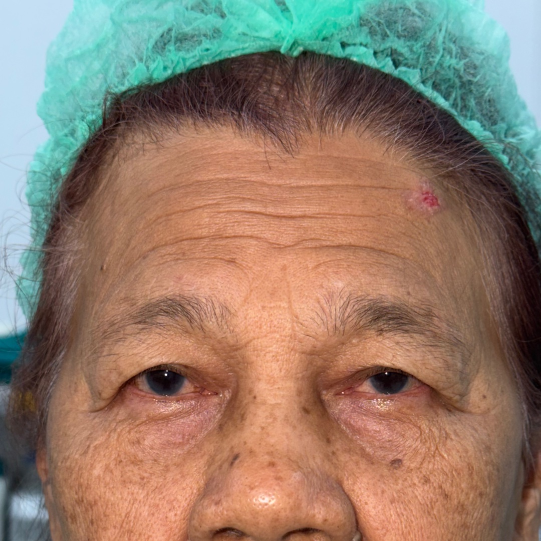 Before Hairline Forehead Lift