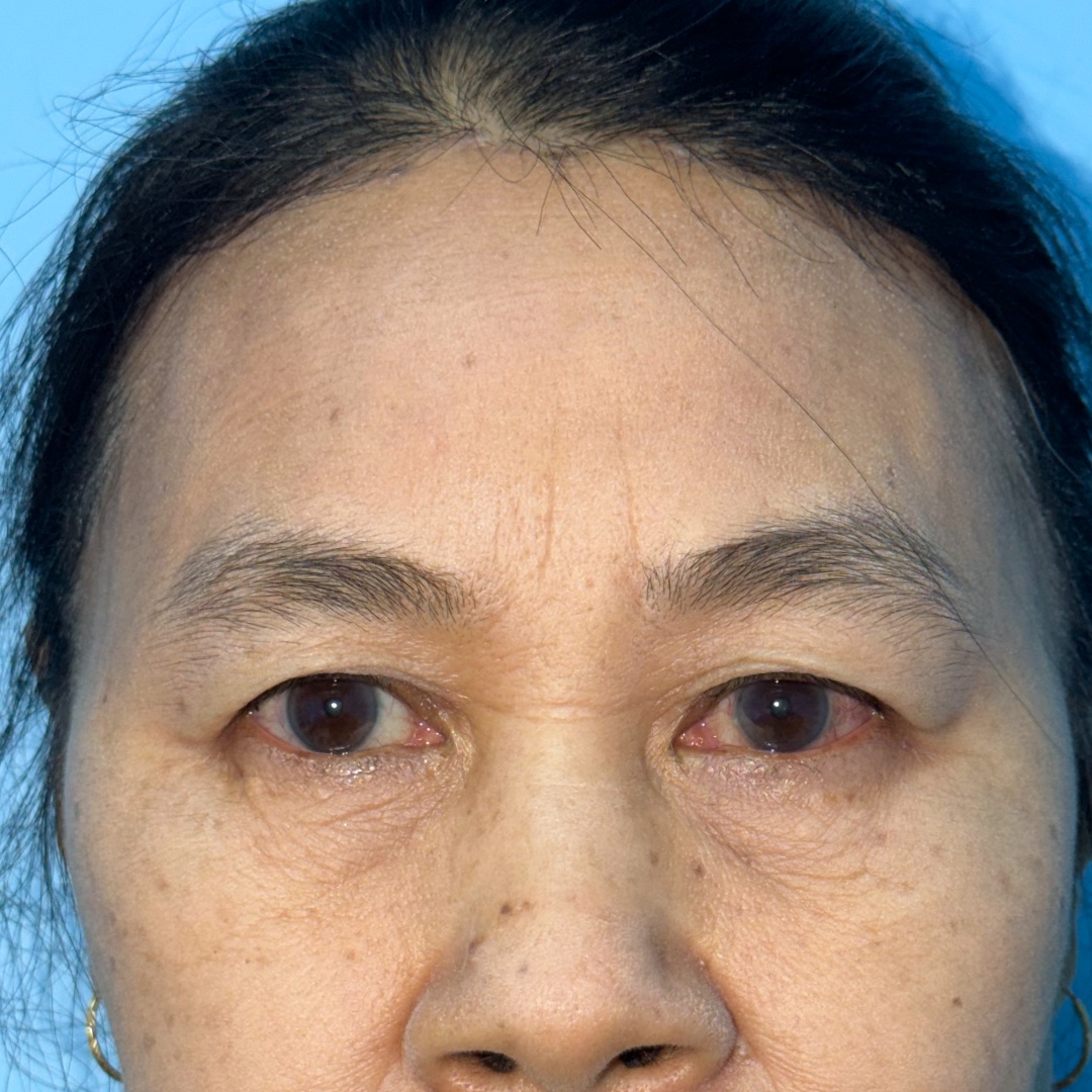 Three months after Hairline Forehead Lift