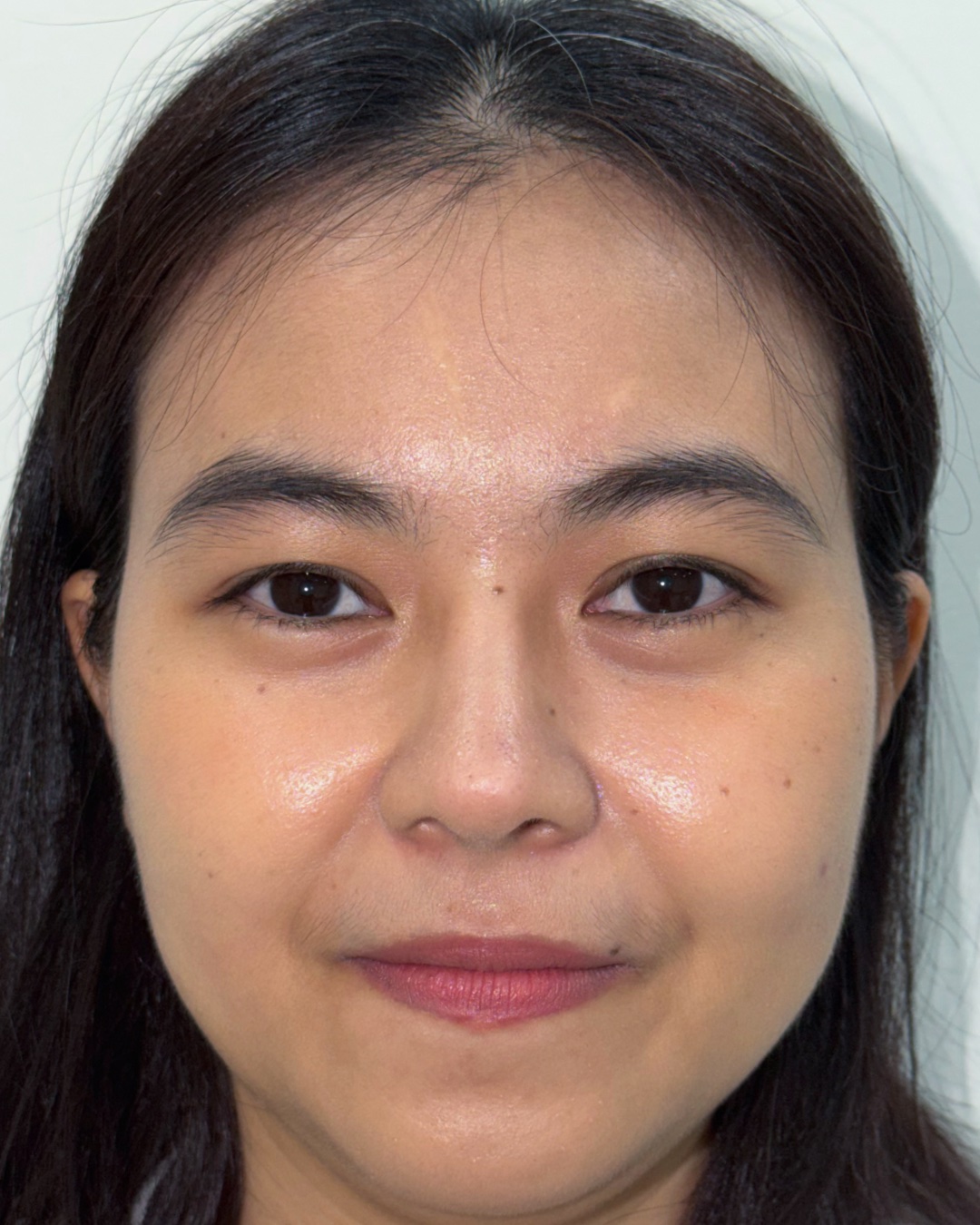Thirteen months after primary rhinoplasty with costal cartilage grafting, front view, Case 016