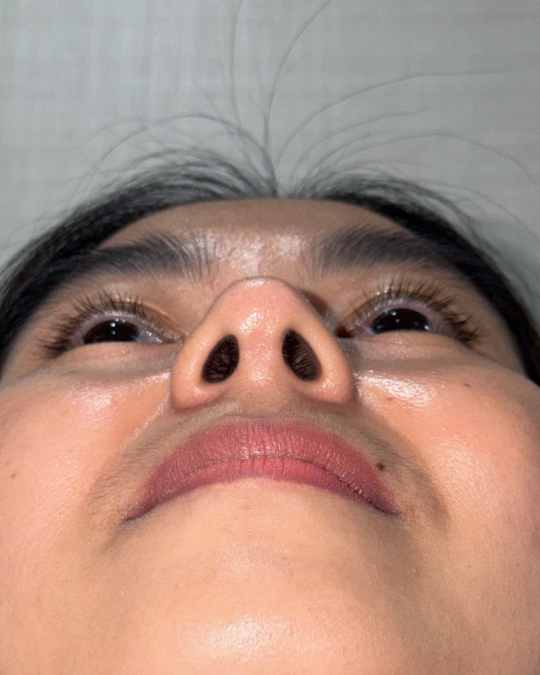 Thirteen months after primary rhinoplasty with costal cartilage grafting, base view, Case 016