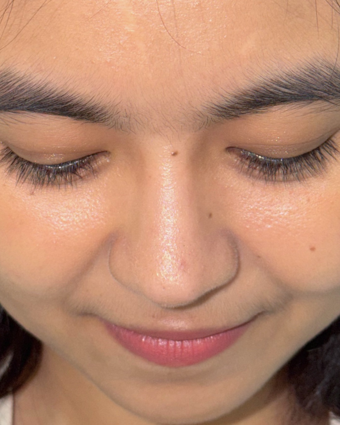 Thirteen months after primary rhinoplasty with costal cartilage grafting, top-down view, Case 016