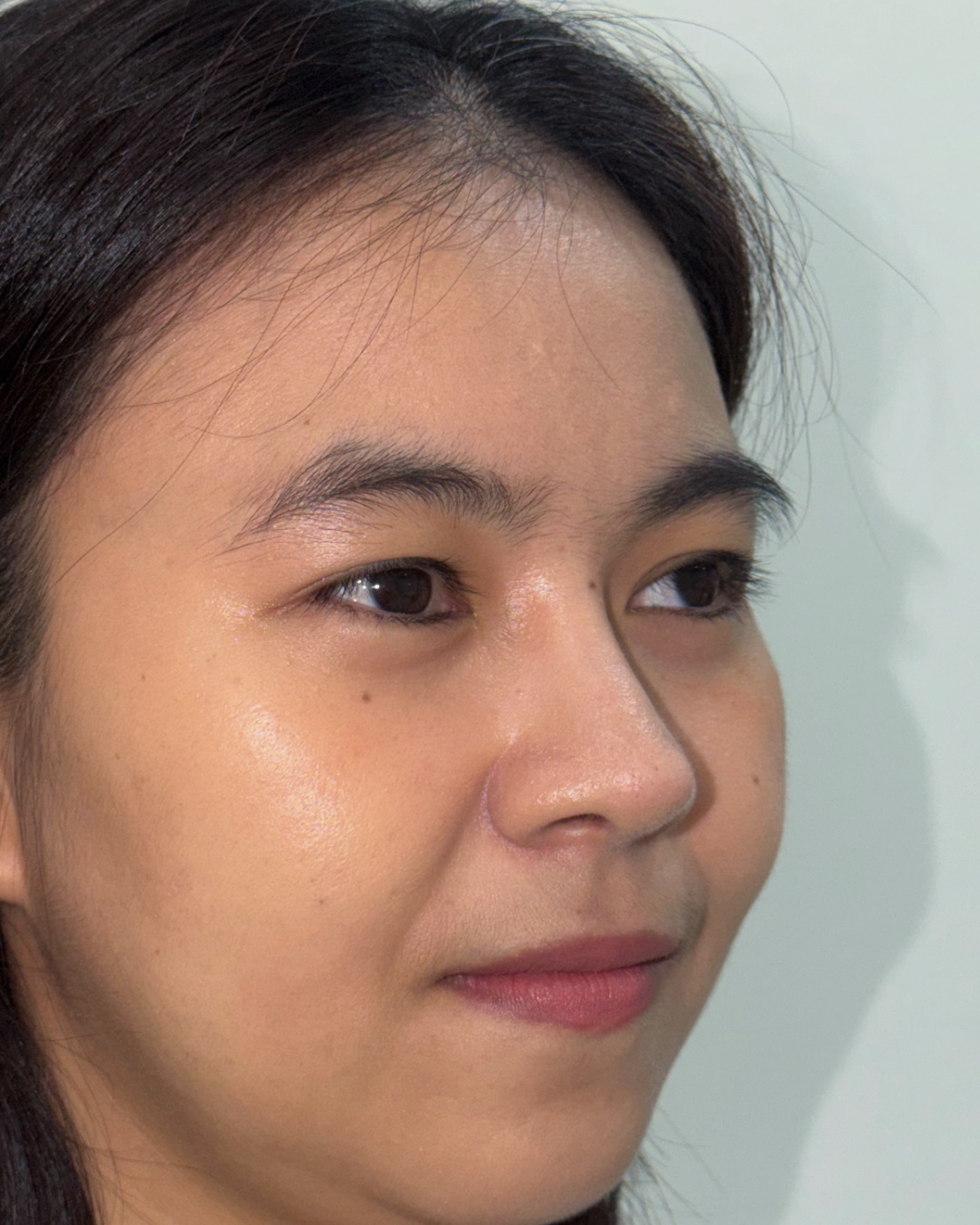 Thirteen months after primary rhinoplasty with costal cartilage grafting, oblique view, Case 016