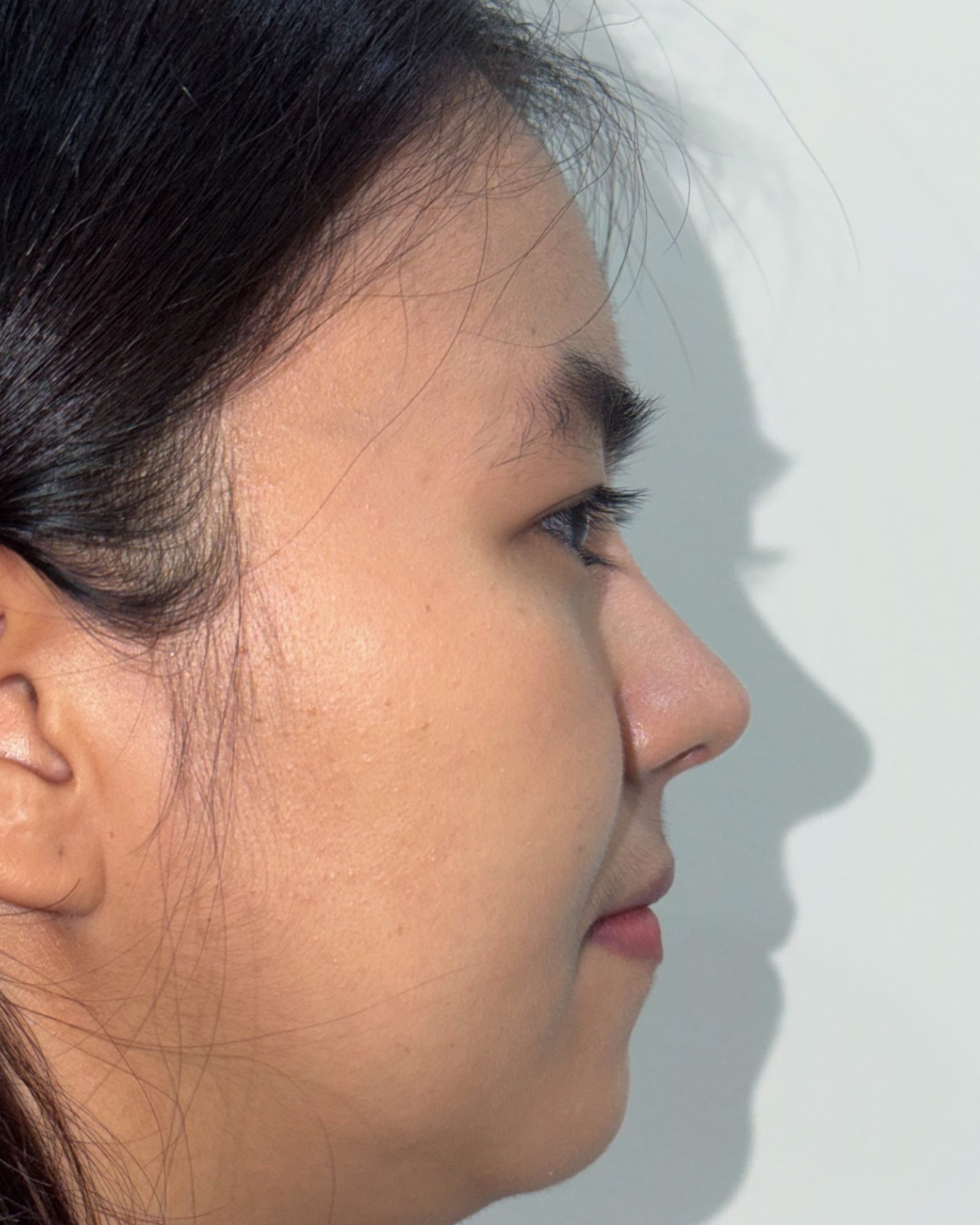Thirteen months after primary rhinoplasty with costal cartilage grafting, profile view, Case 016