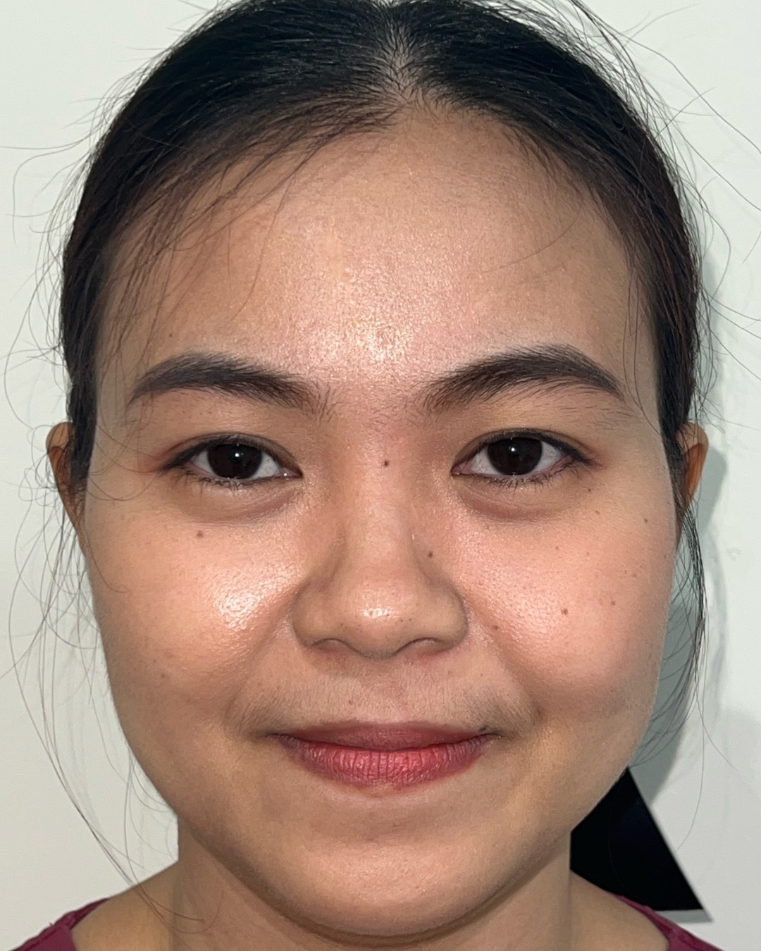 Before primary rhinoplasty with costal cartilage grafting, front view, Case 016