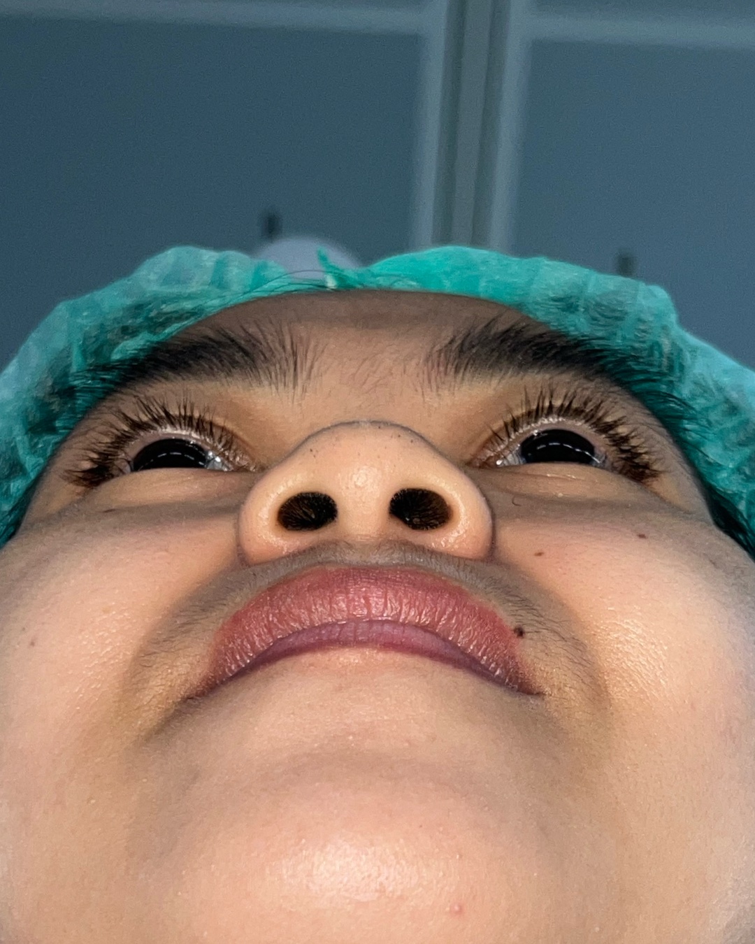 Before primary rhinoplasty with costal cartilage grafting, base view, Case 016