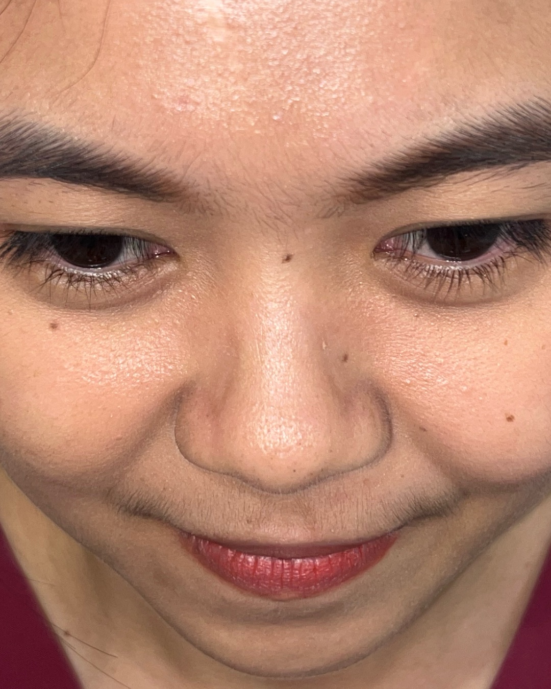 Before primary rhinoplasty with costal cartilage grafting, top-down view, Case 016