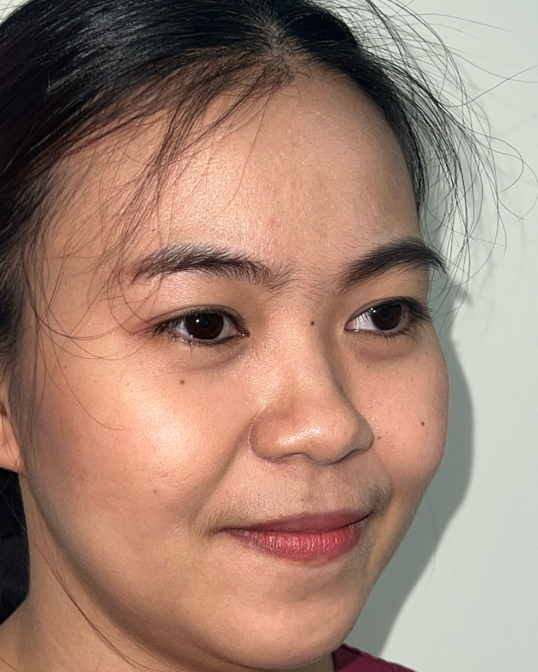 Before primary rhinoplasty with costal cartilage grafting, oblique view, Case 016