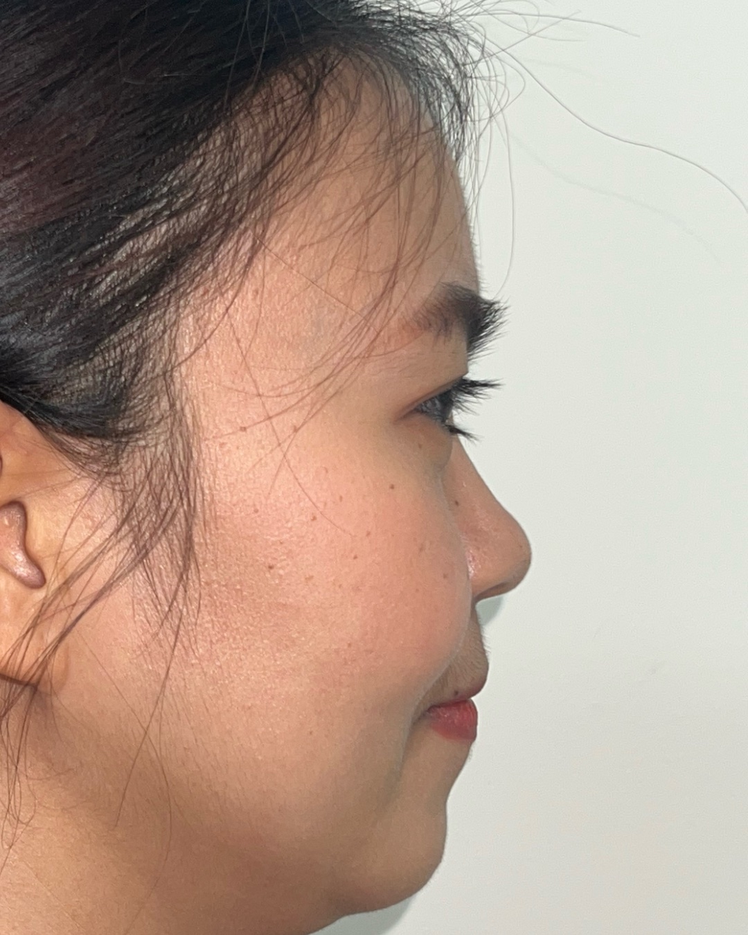 Before primary rhinoplasty with costal cartilage grafting, profile view, Case 016