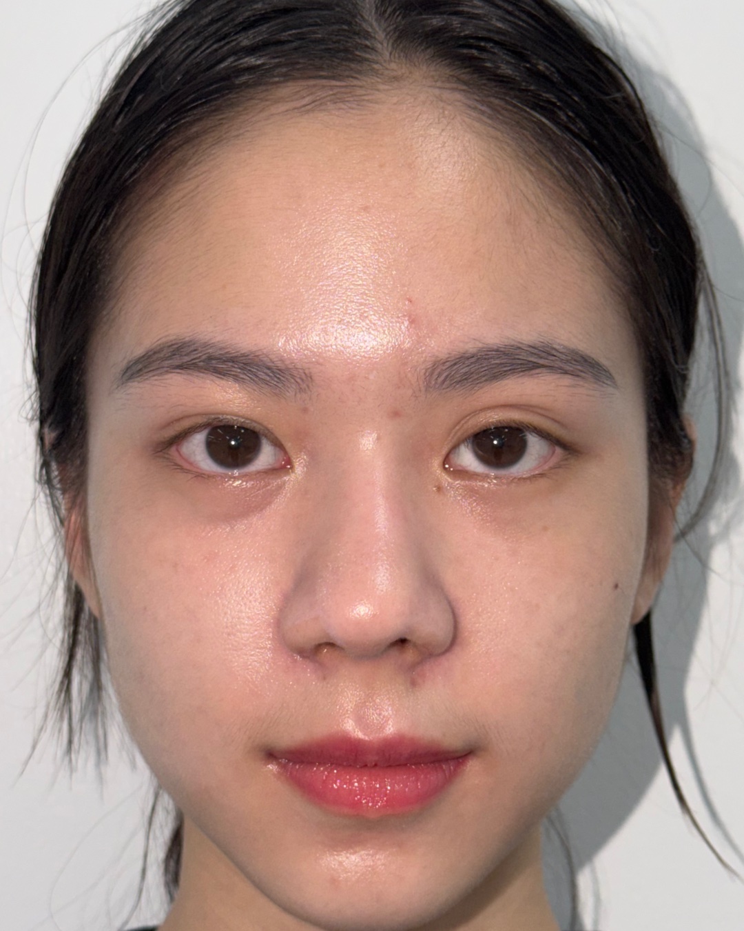 Two months after primary rhinoplasty with costal cartilage grafting, front view, Case 017