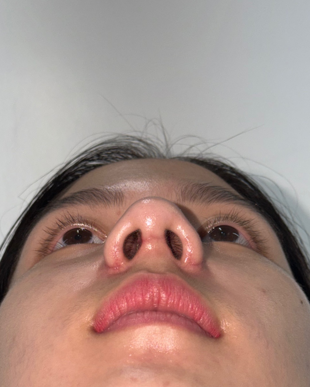Two months after primary rhinoplasty with costal cartilage grafting, base view, Case 017