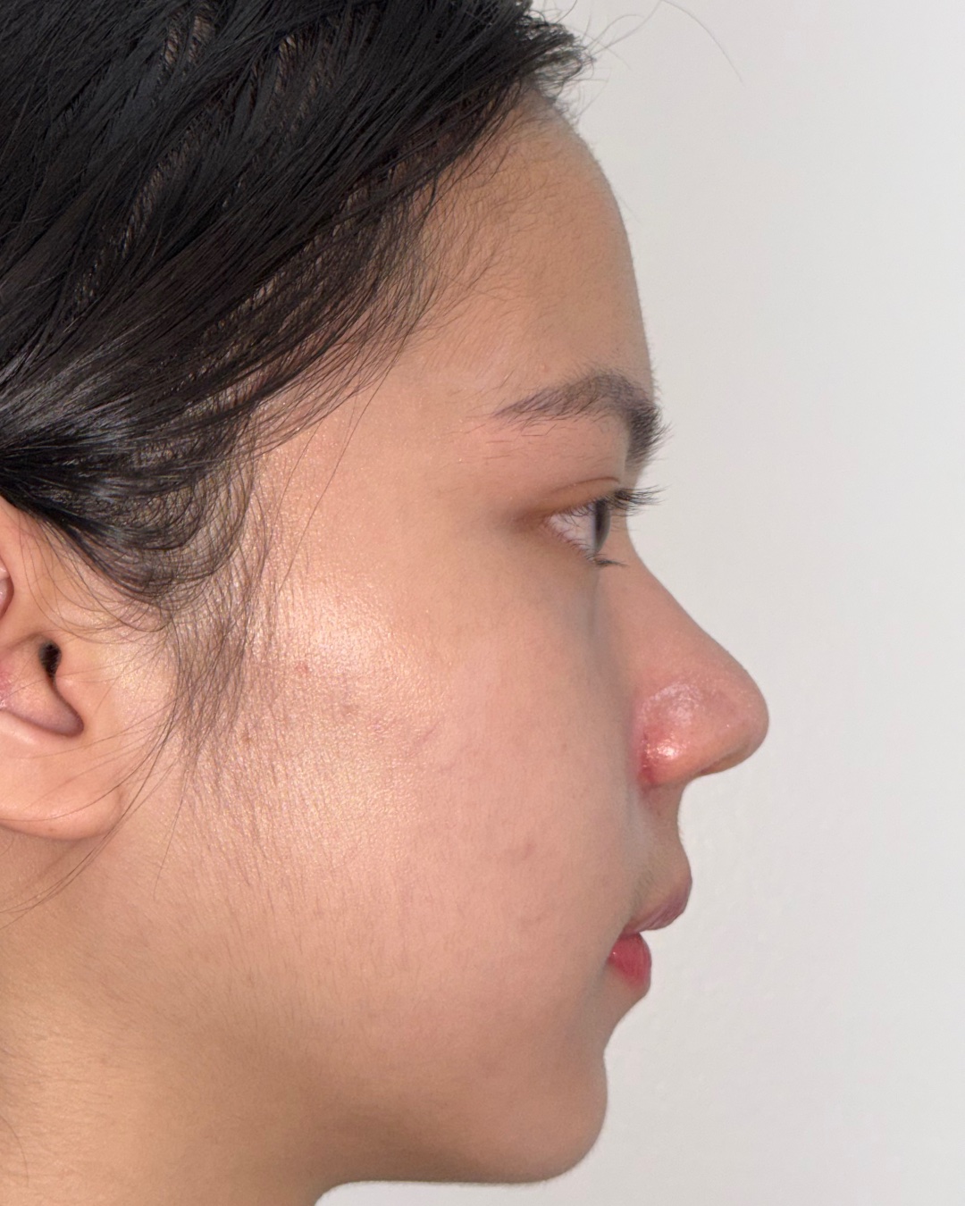 Two months after primary rhinoplasty with costal cartilage grafting, profile view, Case 017