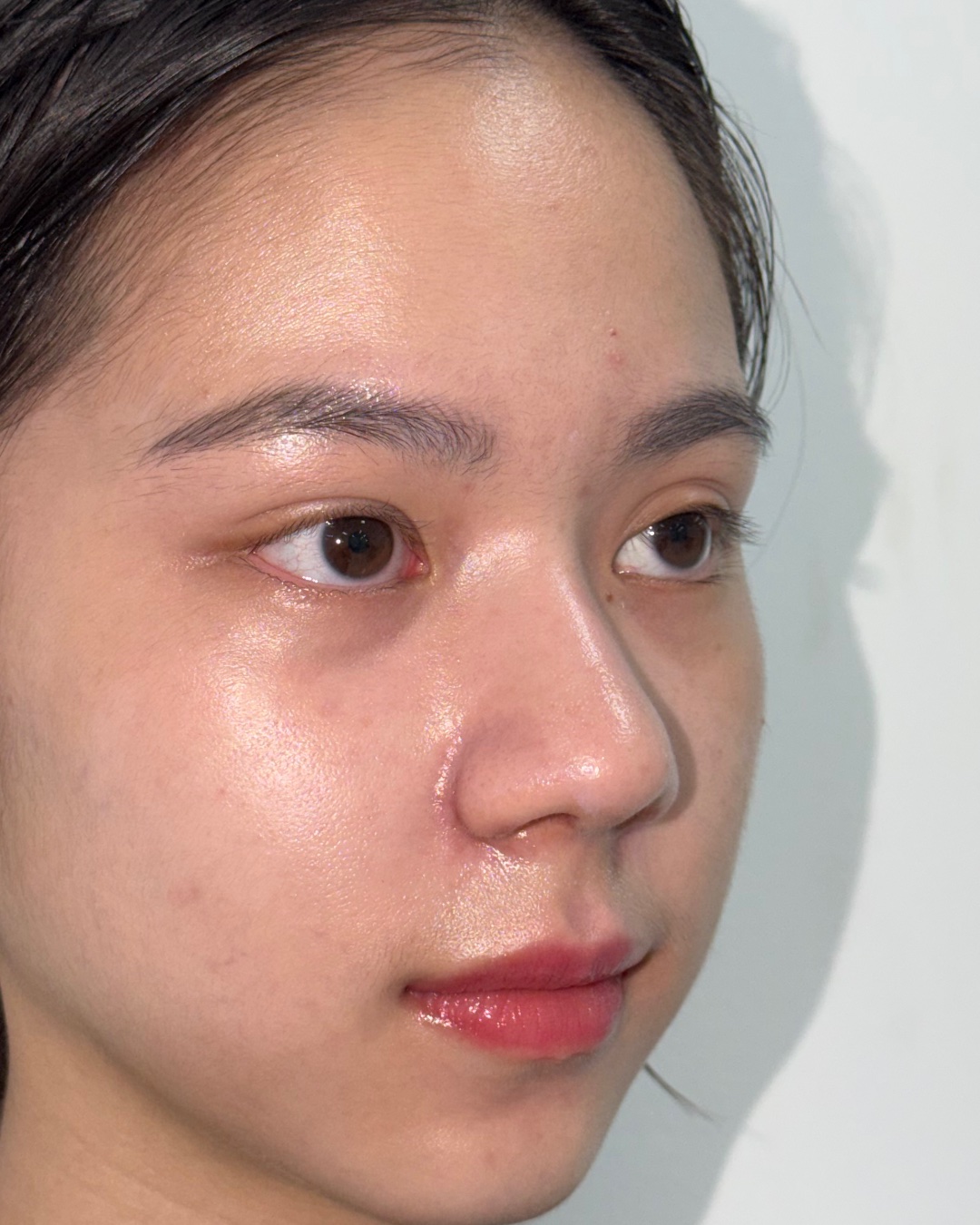 Two months after primary rhinoplasty with costal cartilage grafting, oblique view, Case 017