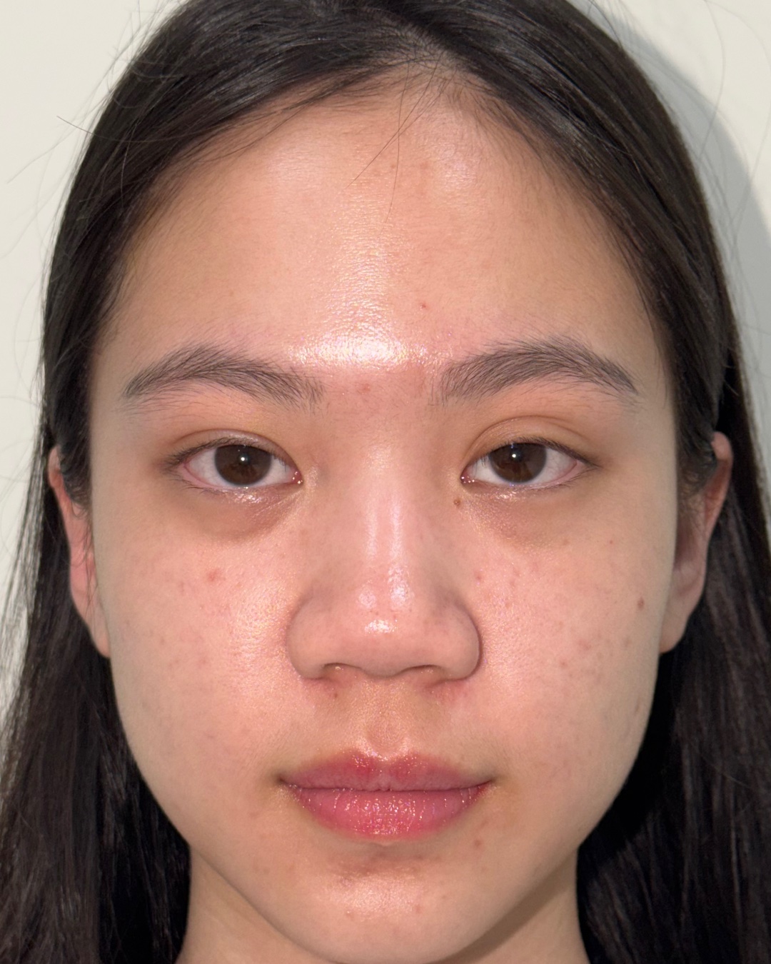 Before primary rhinoplasty with costal cartilage grafting, front view, Case 017