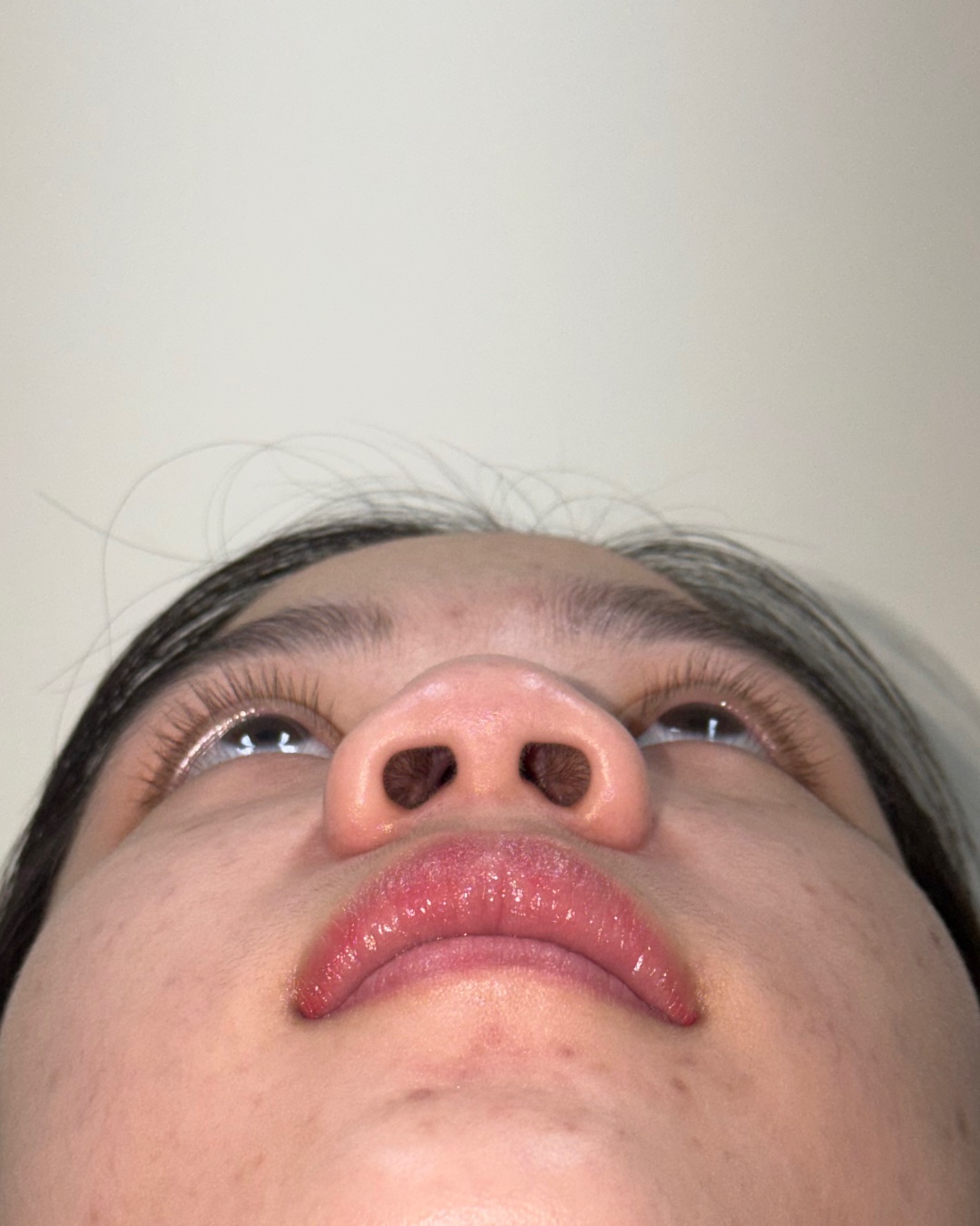 Before primary rhinoplasty with costal cartilage grafting, base view, Case 017
