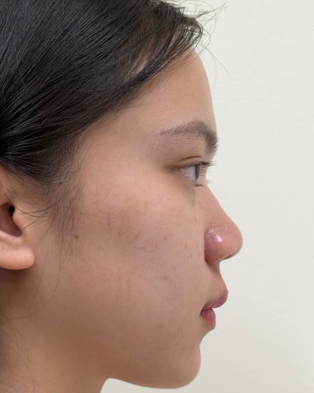 Before primary rhinoplasty with costal cartilage grafting, profile view, Case 017
