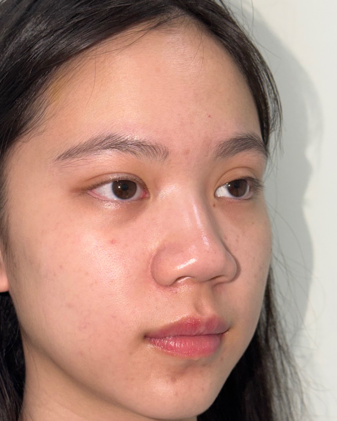 Before primary rhinoplasty with costal cartilage grafting, oblique view, Case 017