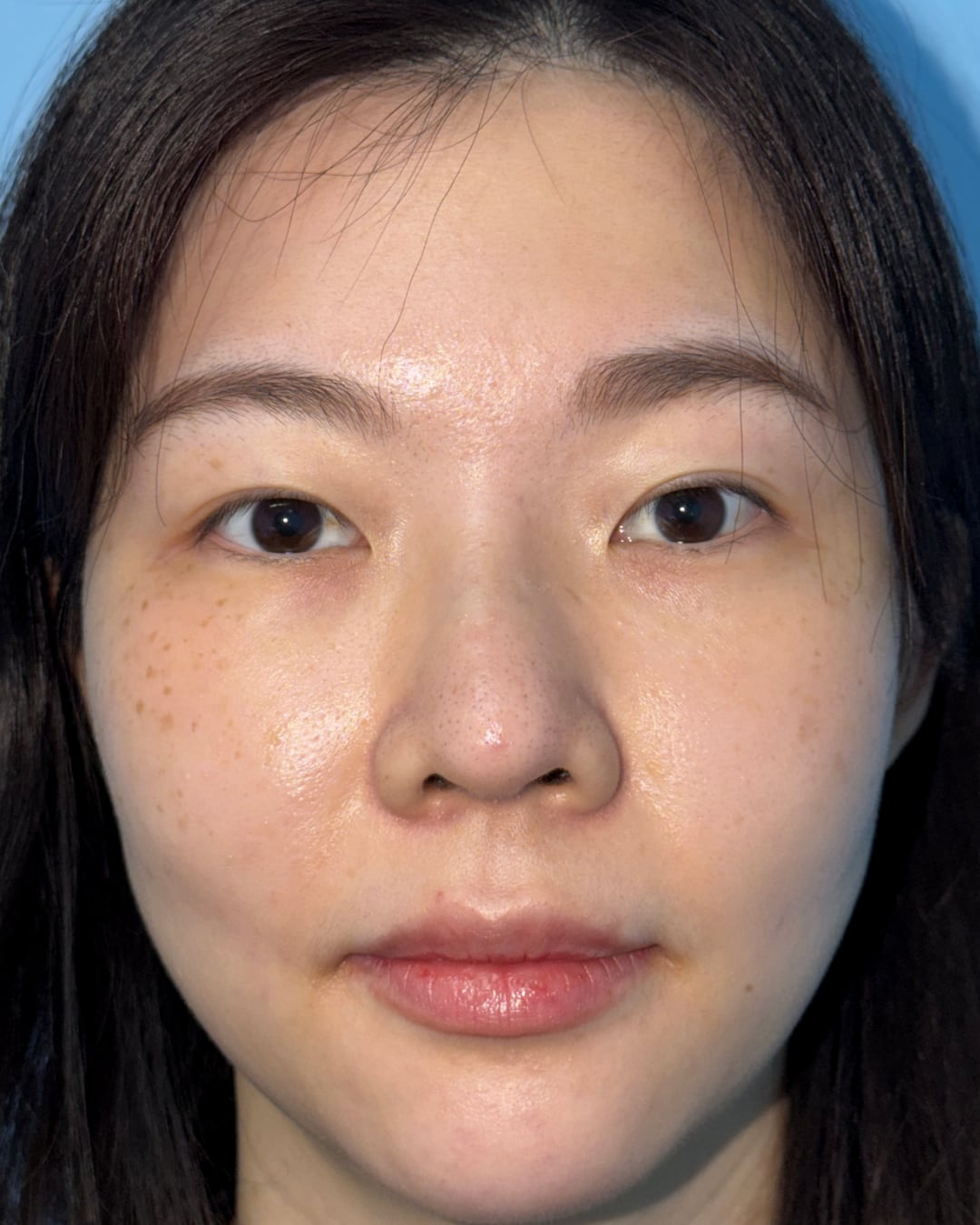 Six months after primary rhinoplasty with hybrid costal cartilage grafting, AP view, Case 018