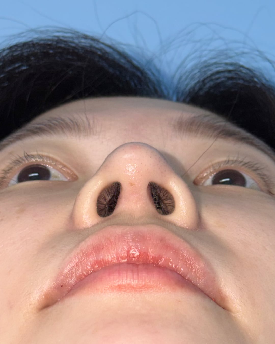 Six months after primary rhinoplasty with hybrid costal cartilage grafting, base view, Case 018