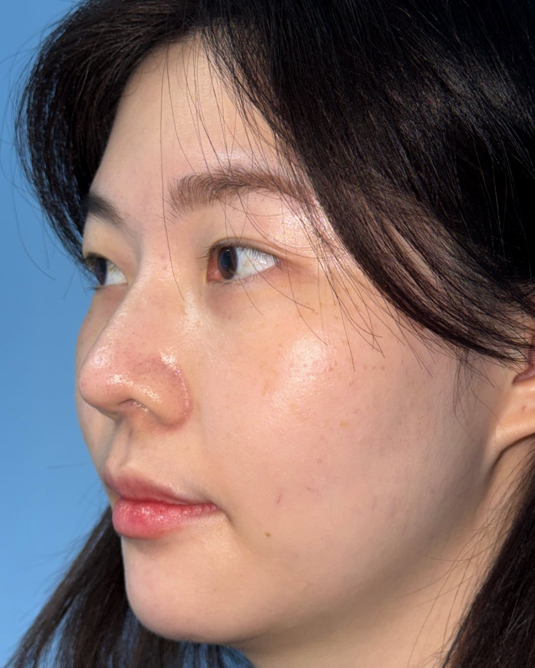 Six months after primary rhinoplasty with hybrid costal cartilage grafting, left oblique view, Case 018