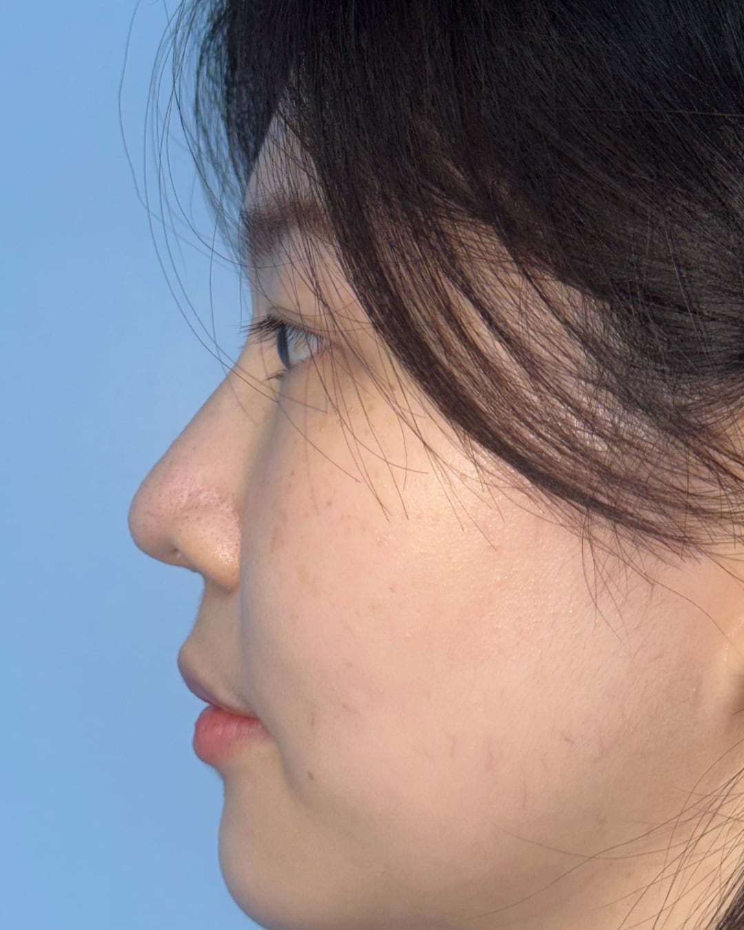 Six months after primary rhinoplasty with hybrid costal cartilage grafting, left profile view, Case 018