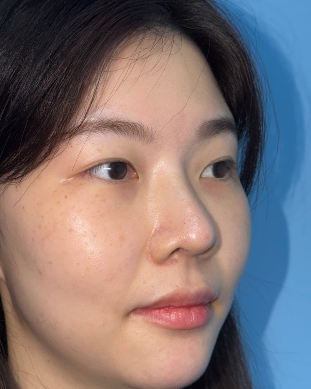Six months after primary rhinoplasty with hybrid costal cartilage grafting, right oblique view, Case 018