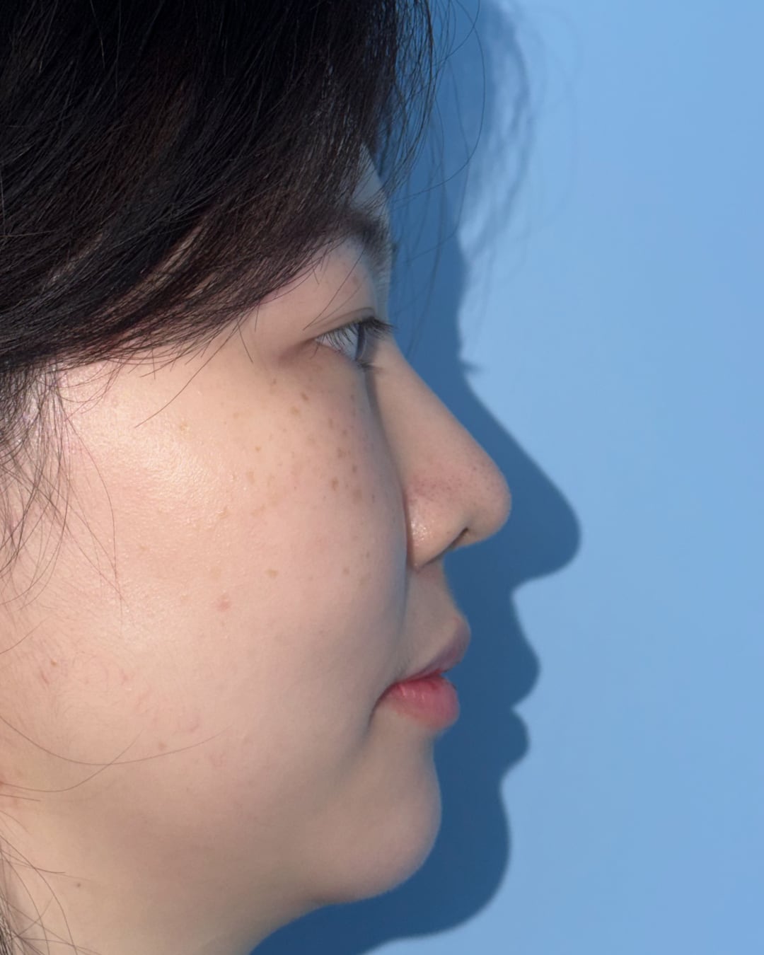 Six months after primary rhinoplasty with hybrid costal cartilage grafting, right profile view, Case 018