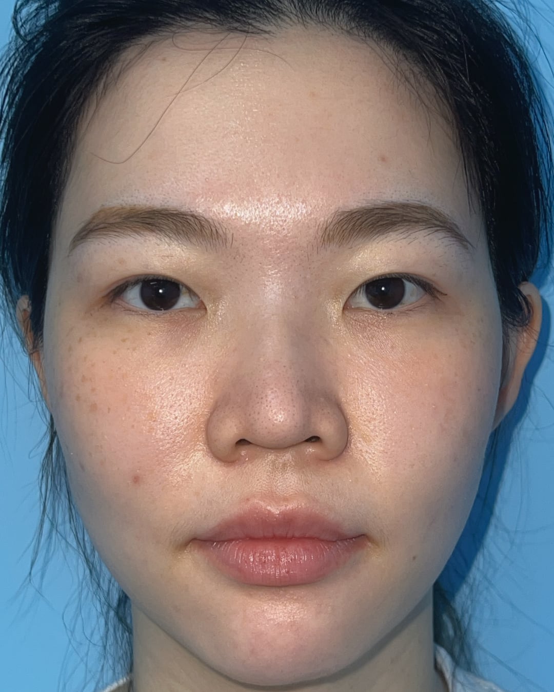 Before primary rhinoplasty with hybrid costal cartilage grafting, AP view, Case 018