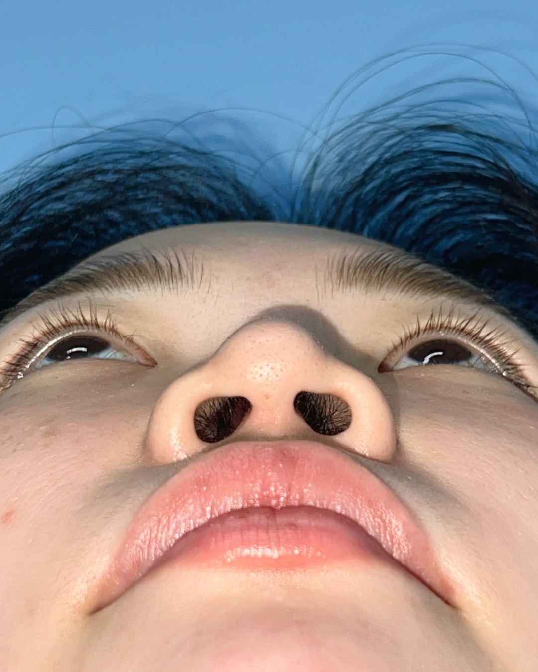 Before primary rhinoplasty with hybrid costal cartilage grafting, base view, Case 018