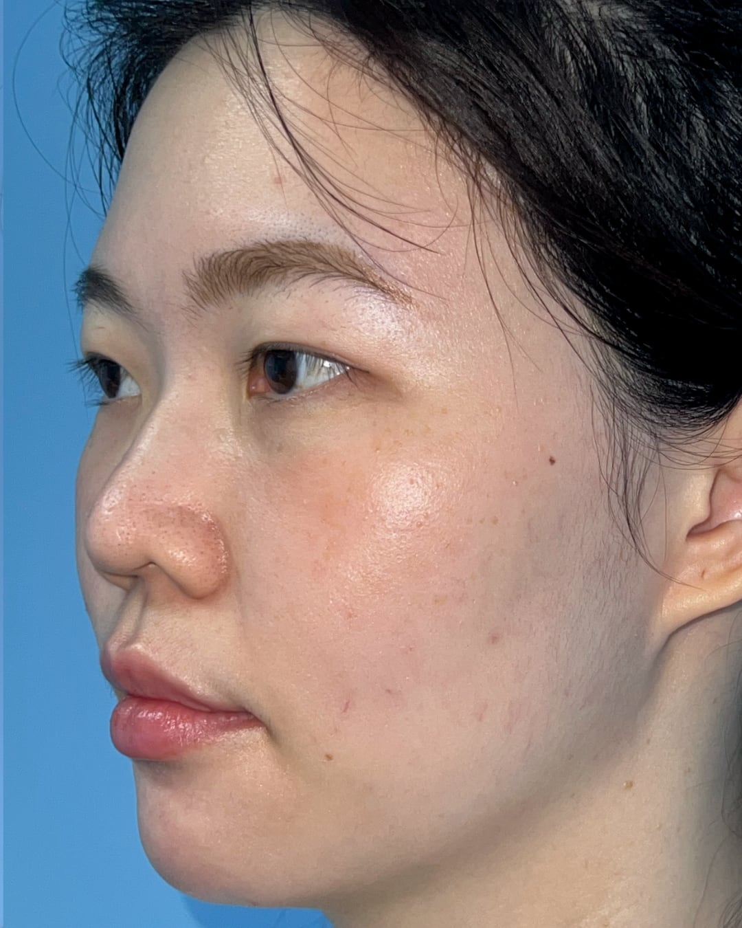 Before primary rhinoplasty with hybrid costal cartilage grafting, left oblique view, Case 018