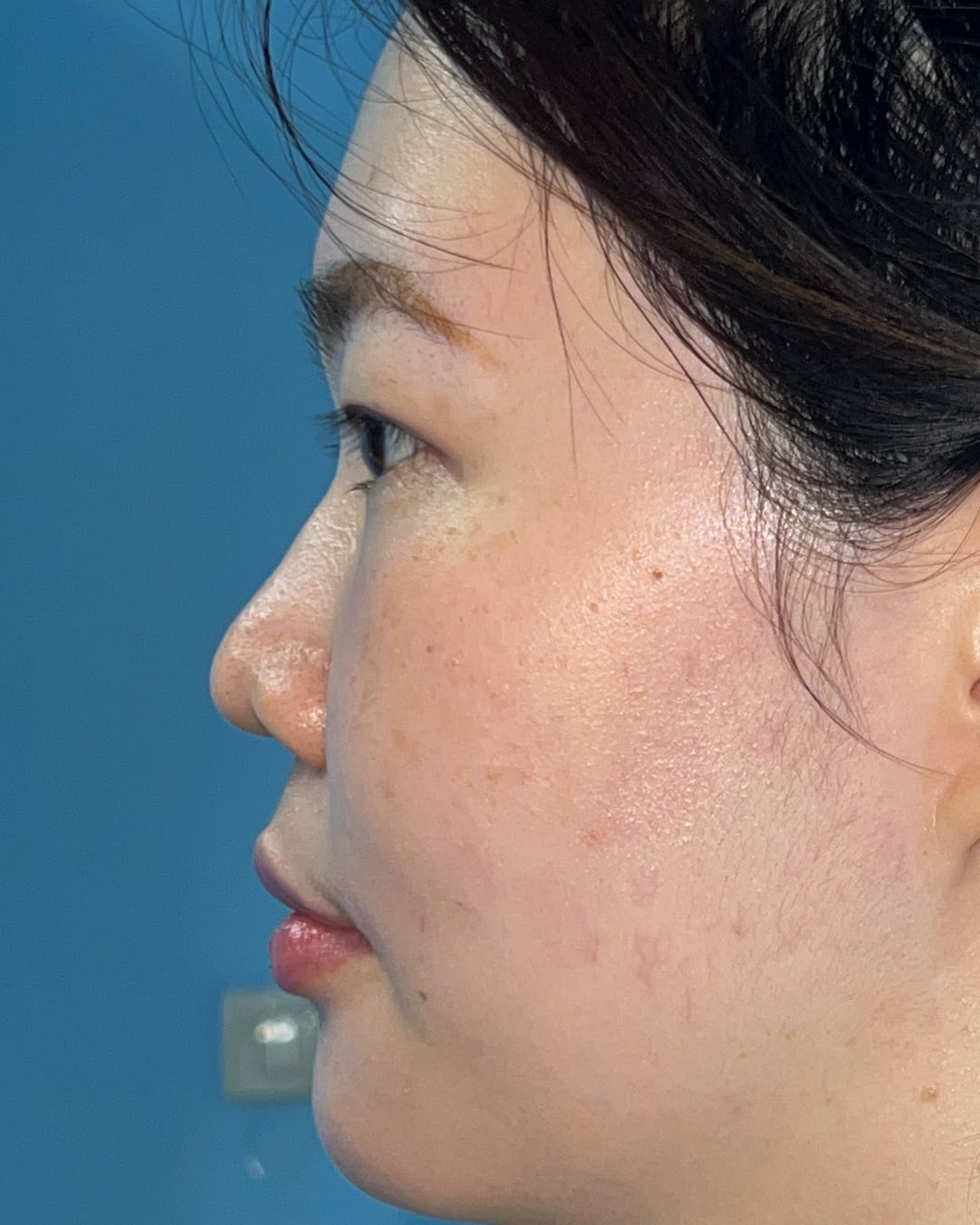Before primary rhinoplasty with hybrid costal cartilage grafting, left profile view, Case 018