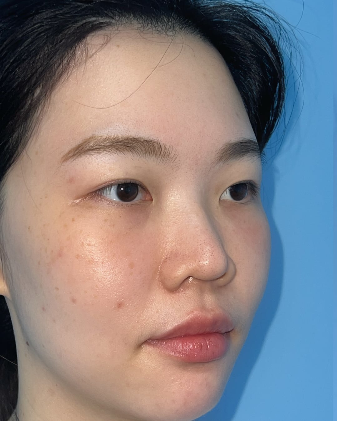 Before primary rhinoplasty with hybrid costal cartilage grafting, right oblique view, Case 018
