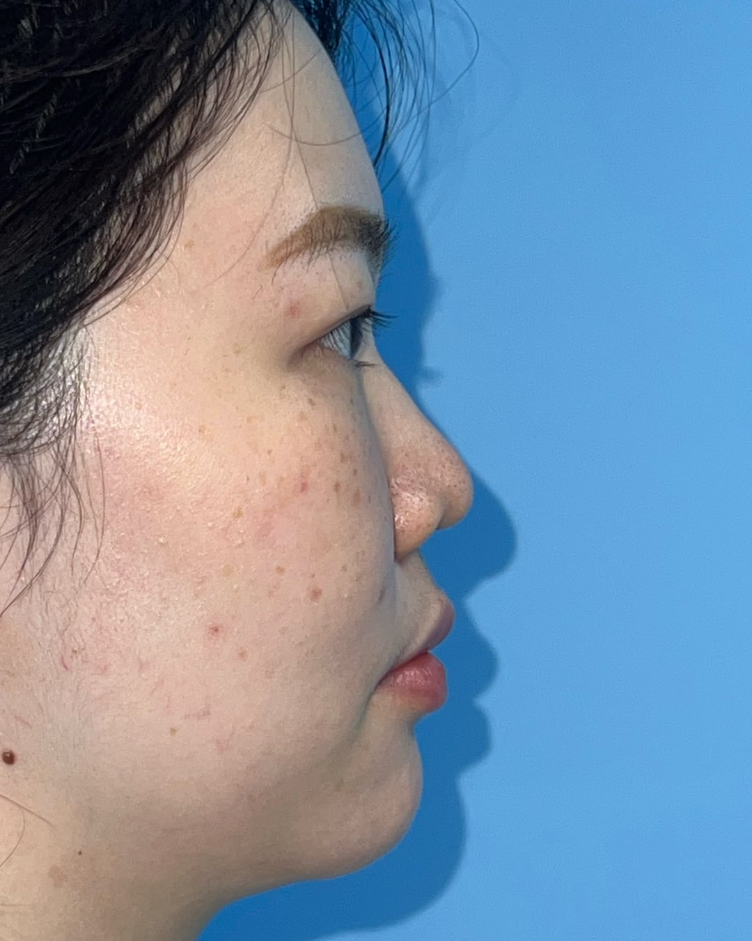 Before primary rhinoplasty with hybrid costal cartilage grafting, right profile view, Case 018