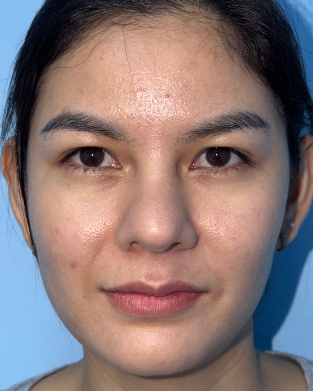 Four months after revision rhinoplasty with costal cartilage grafting, front view, Case 019