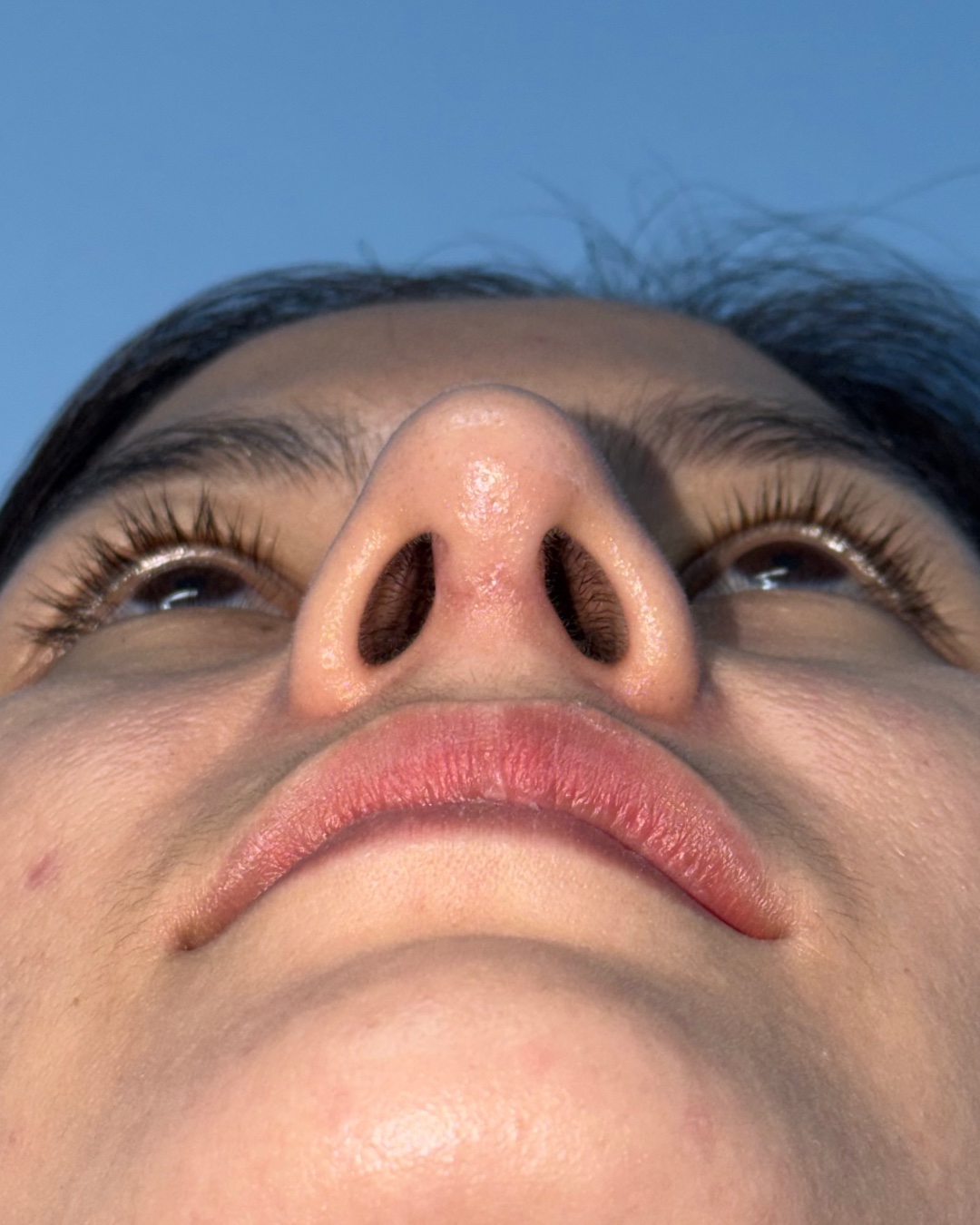 Four months after revision rhinoplasty with costal cartilage grafting, base view, Case 019