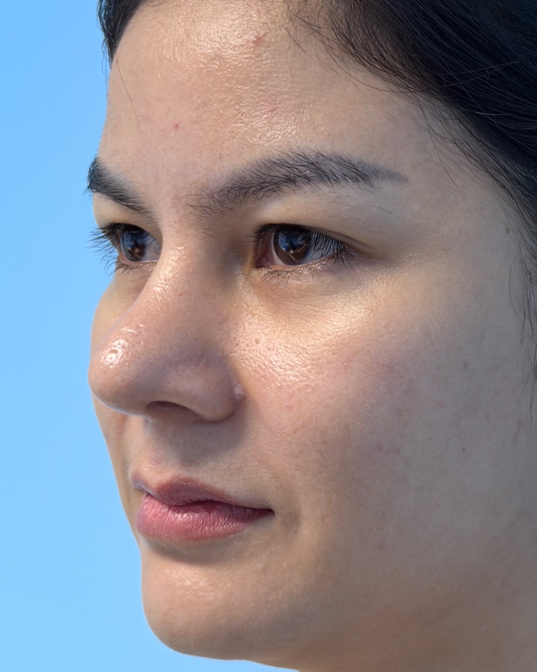 Four months after revision rhinoplasty with costal cartilage grafting, left oblique view, Case 019