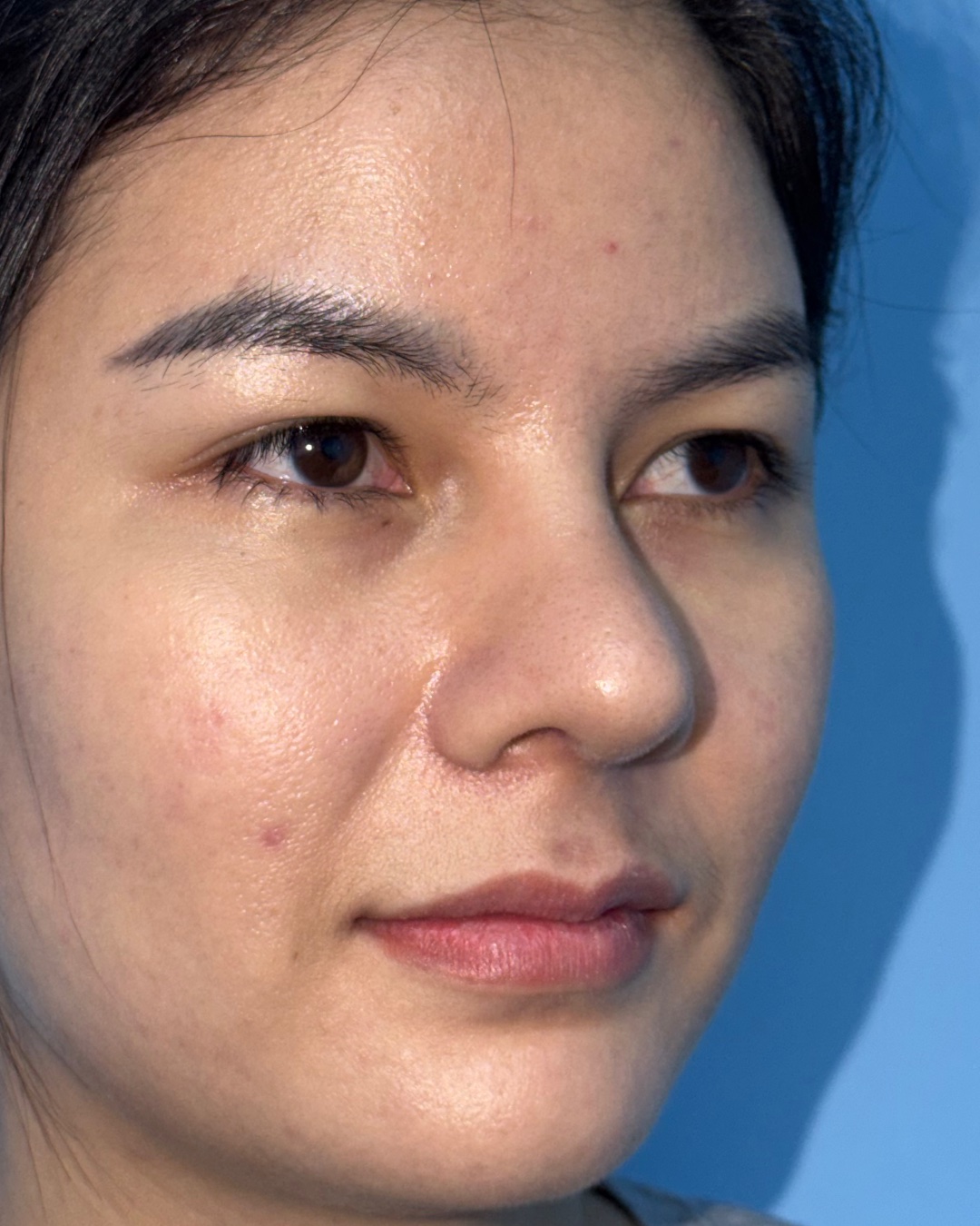 Four months after revision rhinoplasty with costal cartilage grafting, right oblique view, Case 019