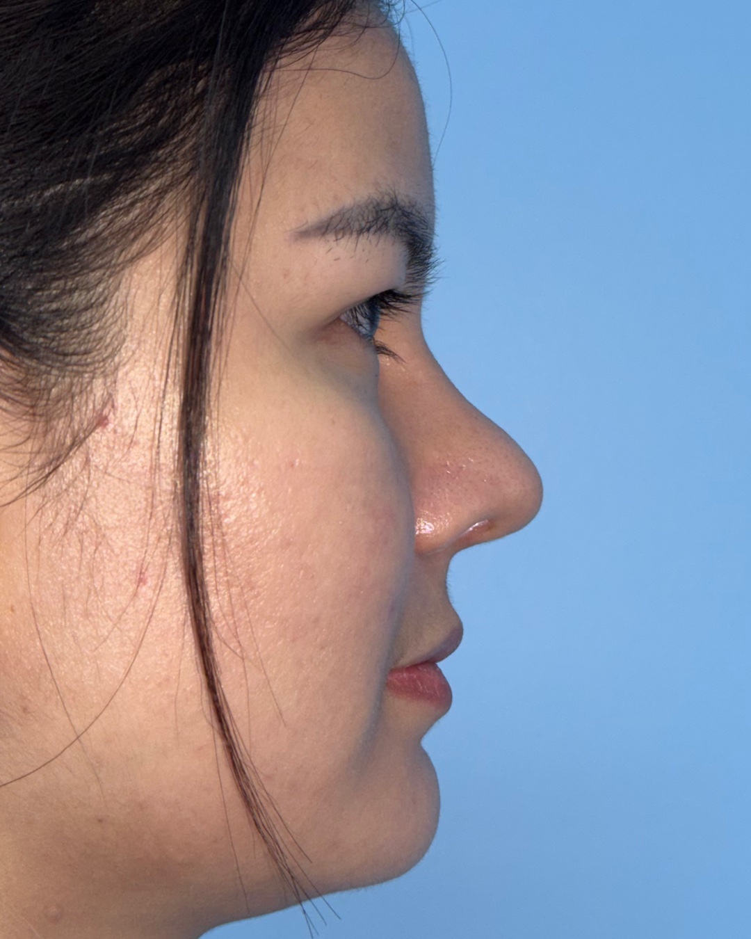 Four months after revision rhinoplasty with costal cartilage grafting, right profile view, Case 019