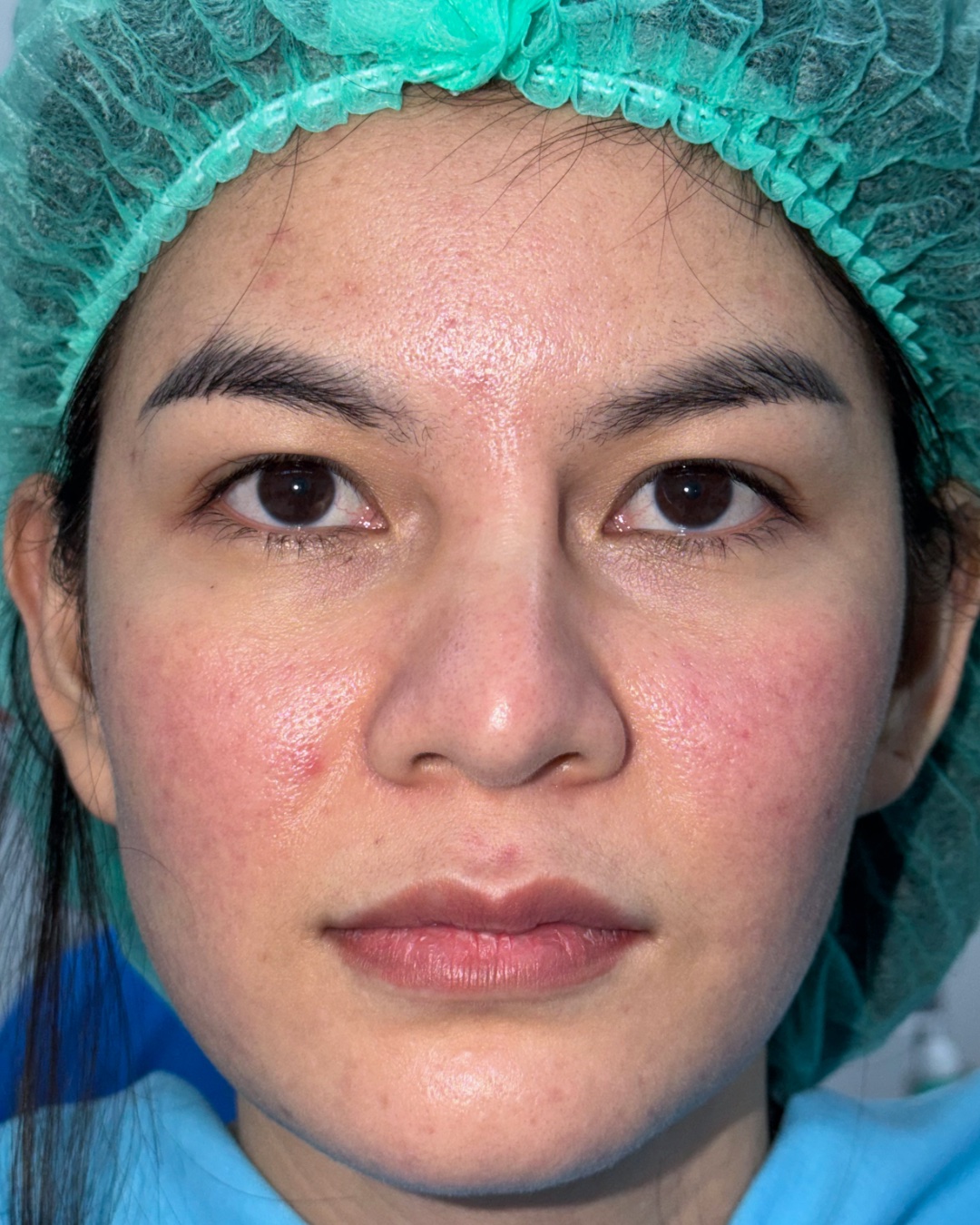 Before revision rhinoplasty with costal cartilage grafting, front view, Case 019