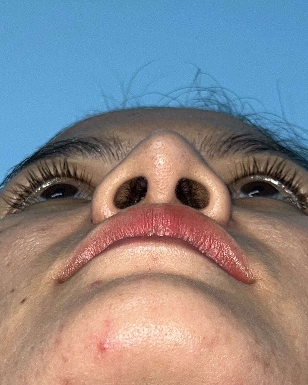 Before revision rhinoplasty with costal cartilage grafting, base view, Case 019